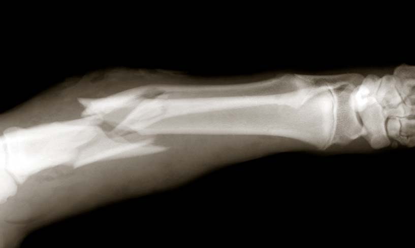 Broken Bones Injury Lawyers