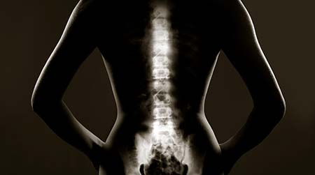 Spinal Cord Injuries